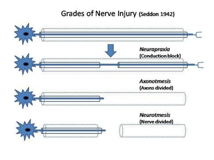 Seddon Classification of Neurological Injuries