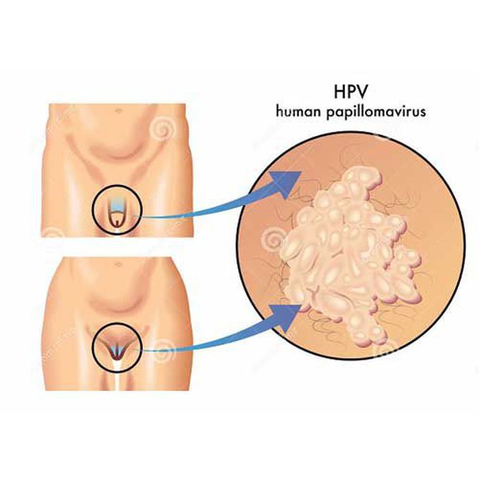 HPV genital warts