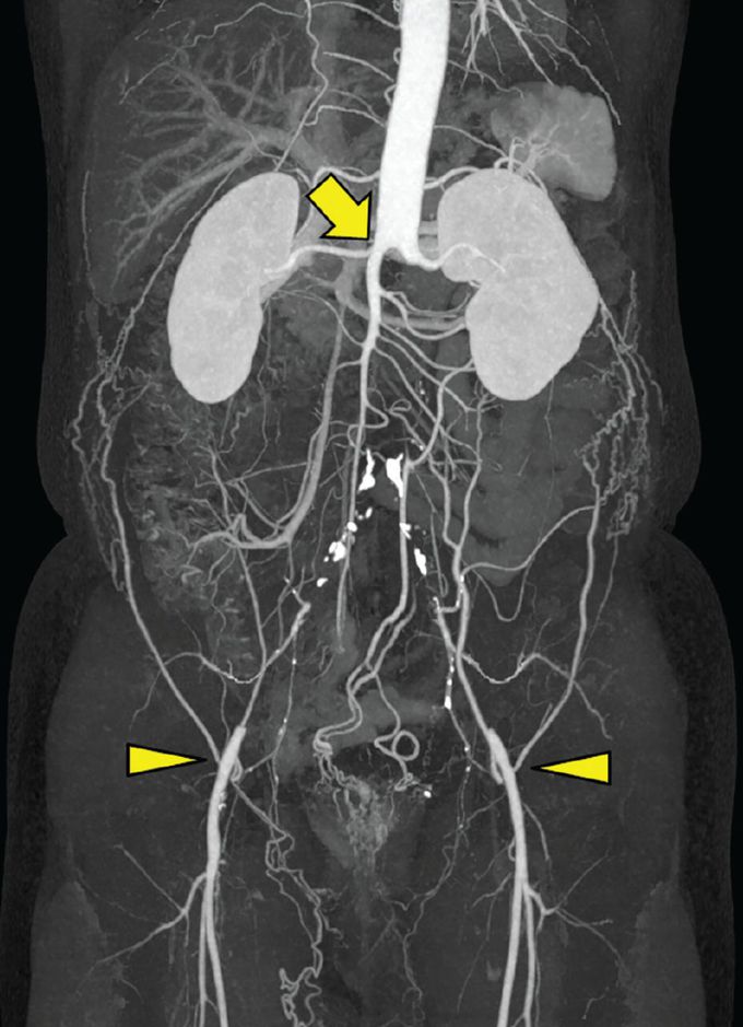 Leriche Syndrome