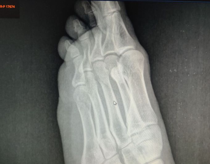 Fracture of the head of 5 metatarsal bone