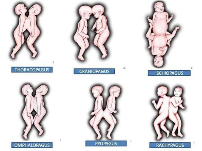 Conjoined /Siamese twins