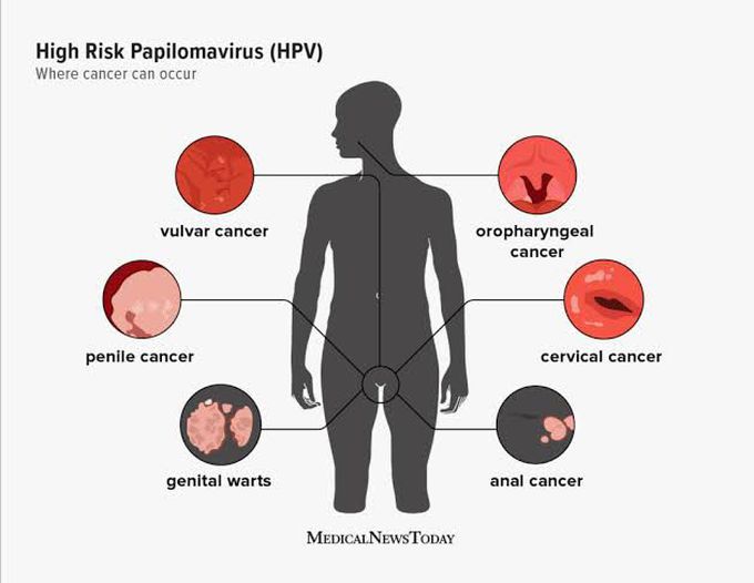 Human papilloma virus