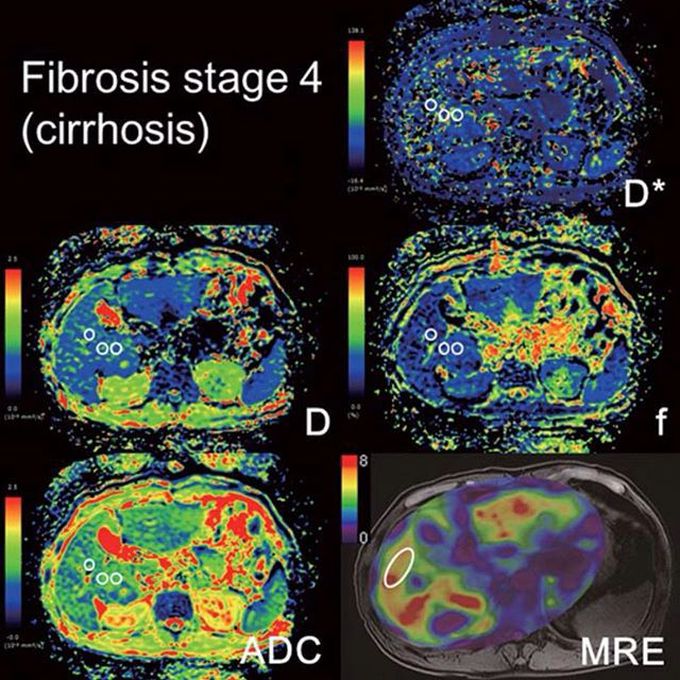 IVIM and MRE images of a 68-year-old woman with cirrhosis (F4)