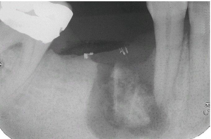 Acute Osteomyelitis with Sequestrum.