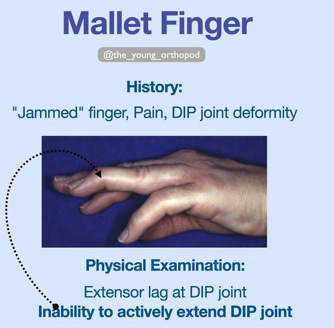 Mallet Finger II