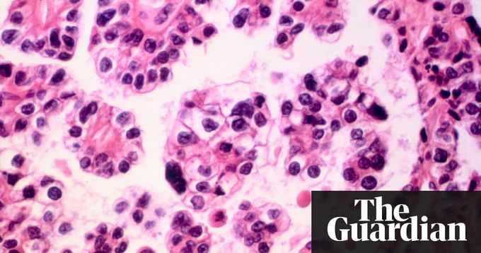 'Holy grail of cancer research': doctors positive about early detection blood test