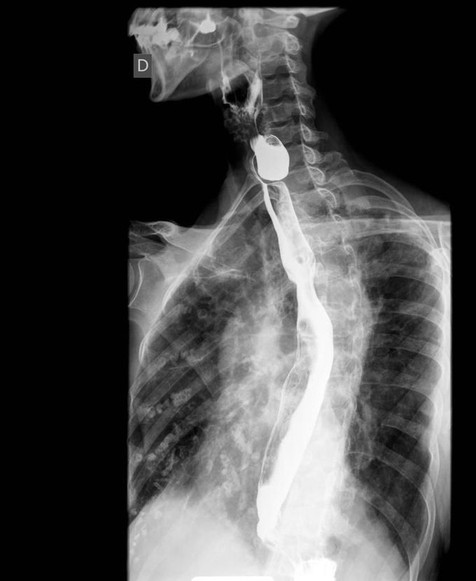 Zenker Diverticulum Radiological Findings