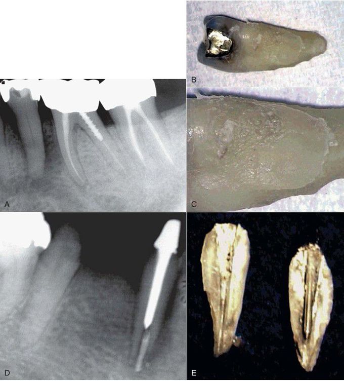 Vertical root fracture