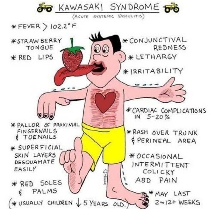 Signs and symptoms of kawasaki syndrome