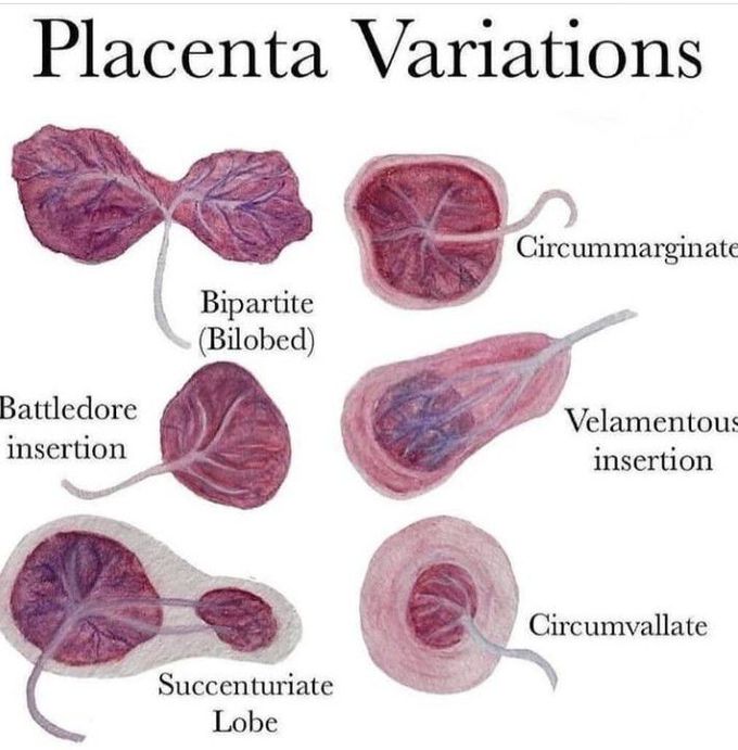 Placental Variations