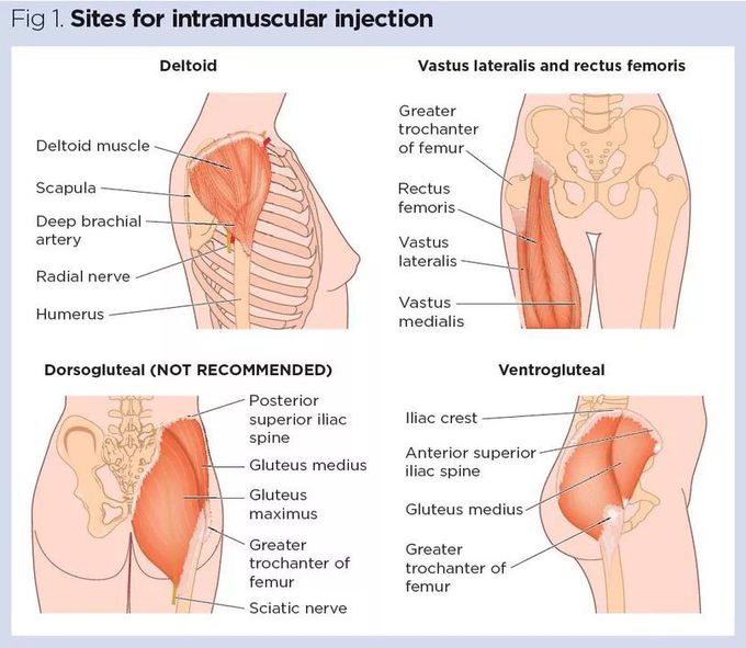 Intramuscular Injection