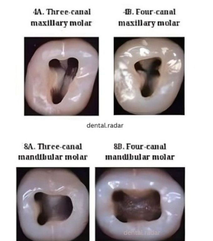 Root Canal Shape II