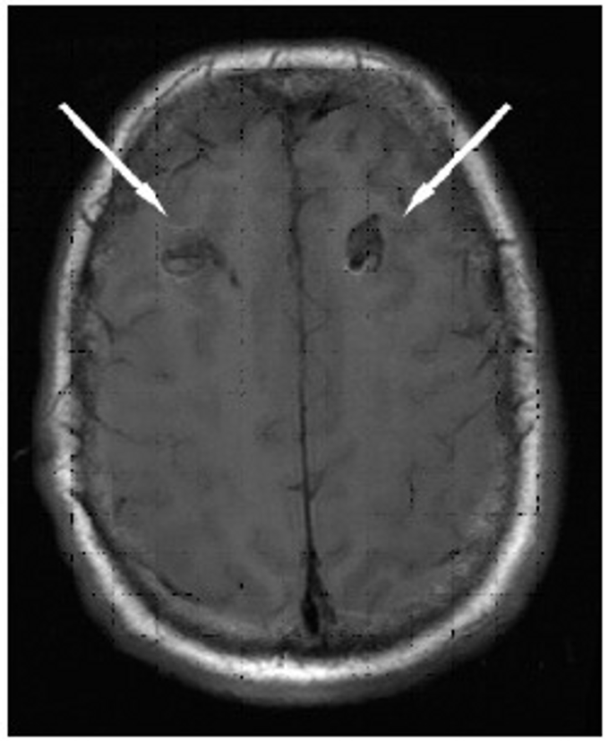 Case Of Brain Abscess Because Of Untreated Tooth Caries