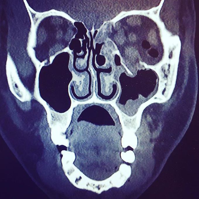 Orbital floor fracture