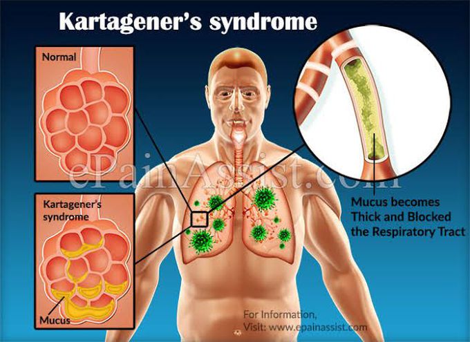 Kartagener syndrome