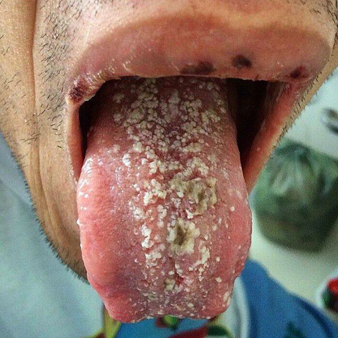 Oral candidiasis