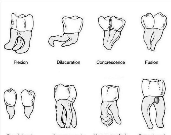 tooth abnormalities