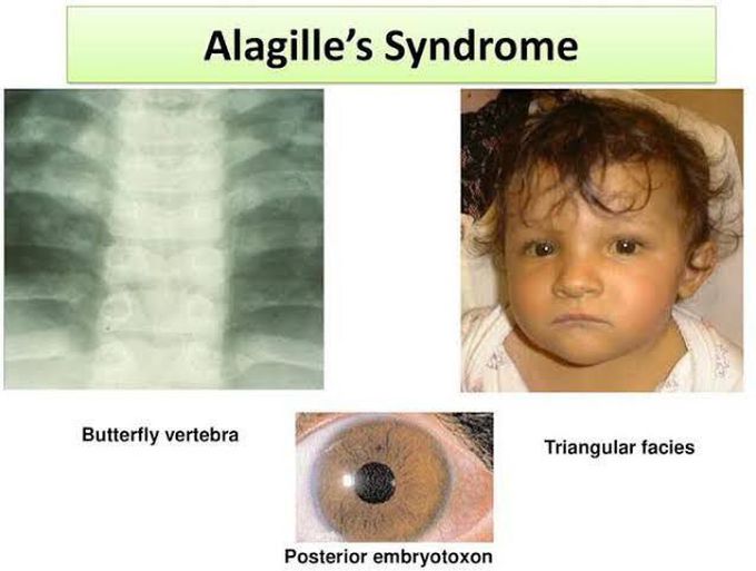 causes of allagile syndrome