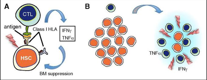 Acquired aplastic anaemia