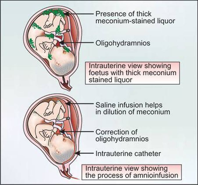 Meconium