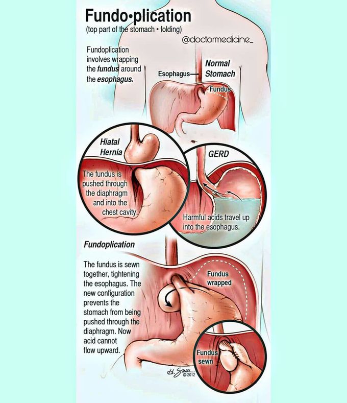 Fundoplication procedure