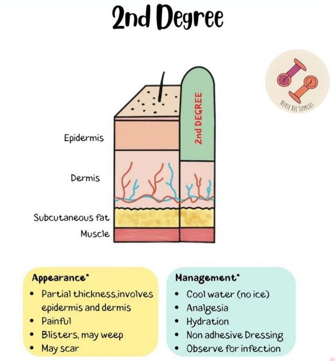 2nd Degree Burn