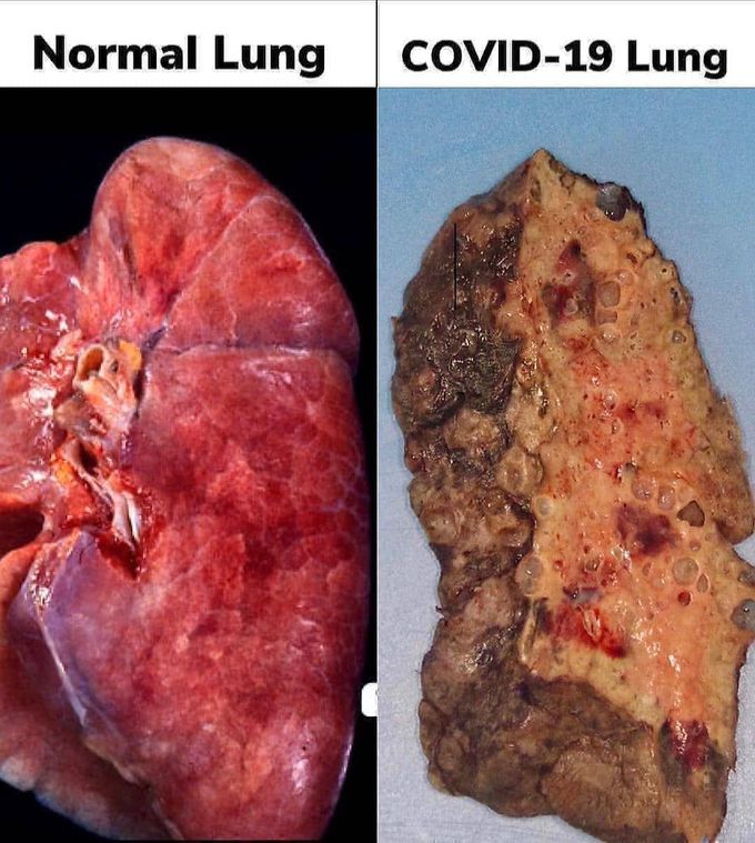 Normal Vs covid-19 lungs