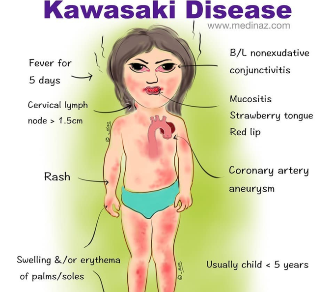 Kawasaki disease