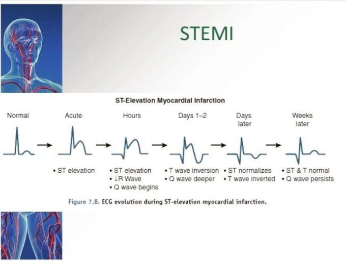 STEMI