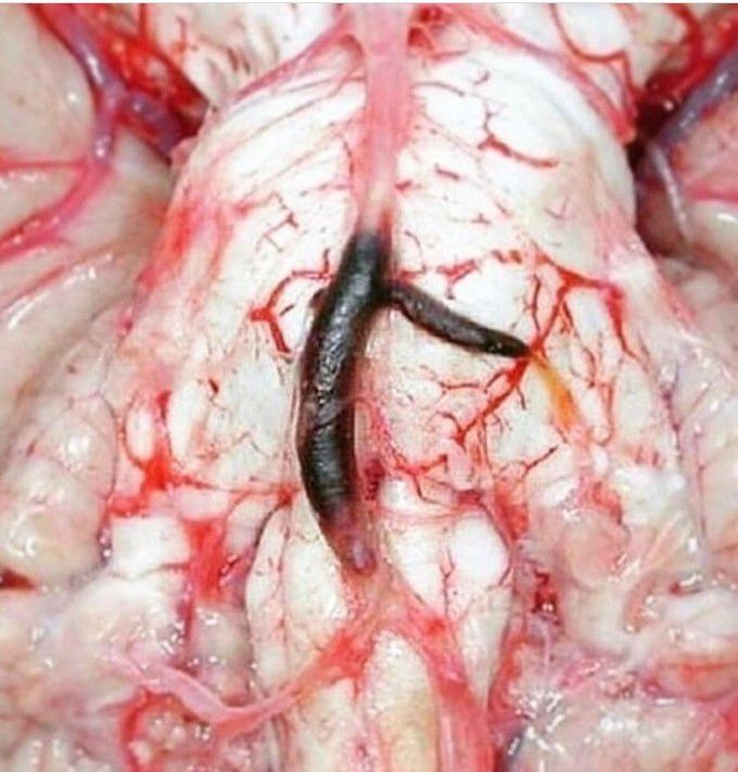 Diagnosis ?