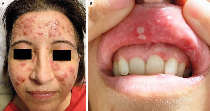 Papulopustular Rash in Behçet’s Disease