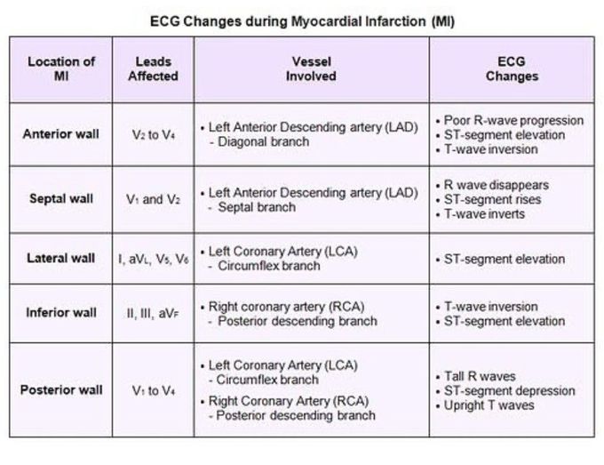 ECG during MI