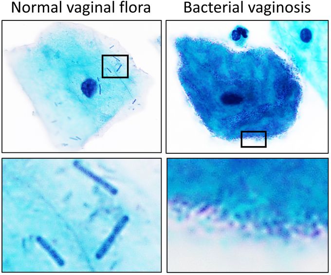 Cause of bacterial vaginosis