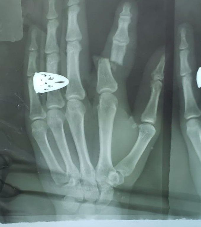 Index finger (left) middle phylnx displaced Fx