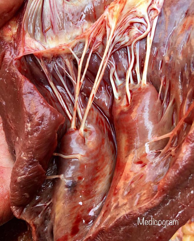 Papillary muscles & cordae tendineae of the heart