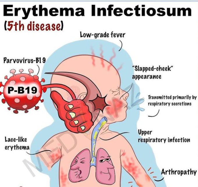 Erythema Infectiosum-Visual Mnemonic