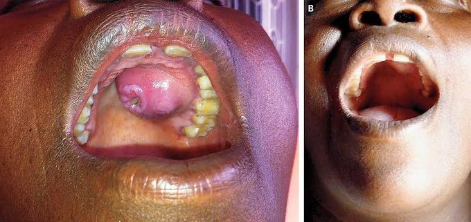 Syphilitic Gumma