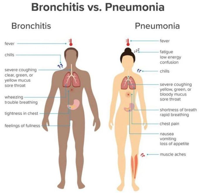 Bronchitis Vs Pnemonia