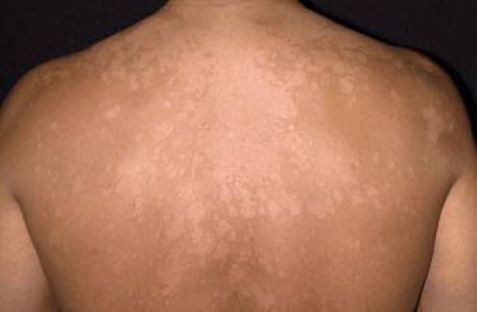 Tinea Versicolor