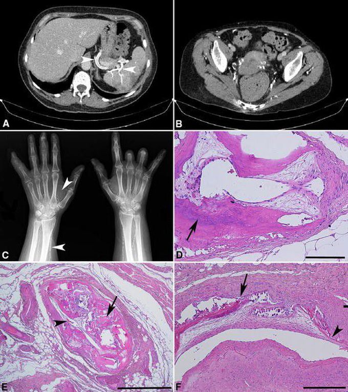 Monckeberg Medial Calcific Sclerosis