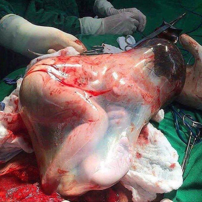 A healthy little baby, born inside the intact amniotic sac!