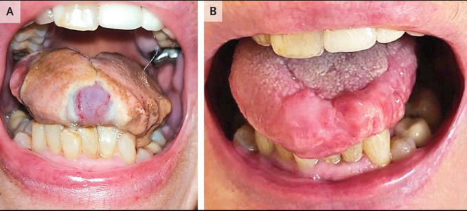 Tongue Necrosis in Giant-Cell Arteritis