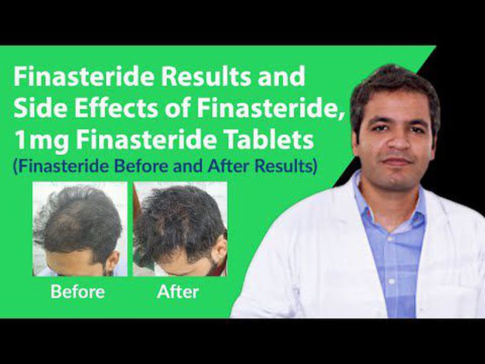 Finasteride for Hair Regrowth