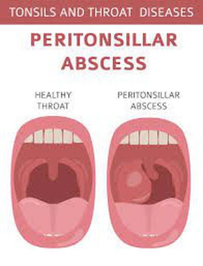 Peritonsilar abcess