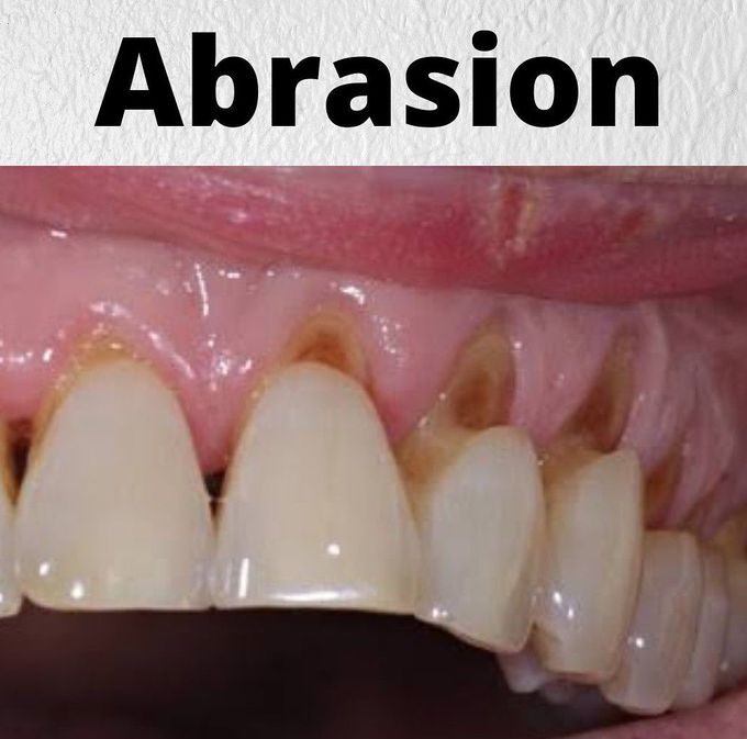 Abrasion