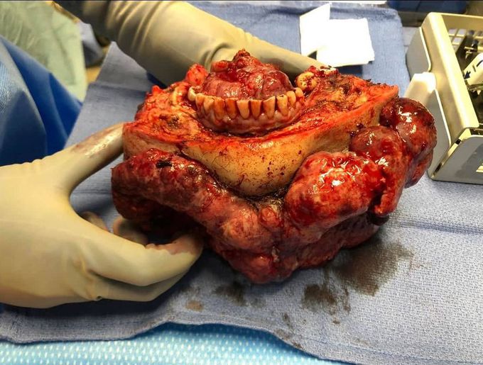 Massive tomor resection (squamous cell carcinoma) with mandibulectomy, neck dissection and laryngectomy!