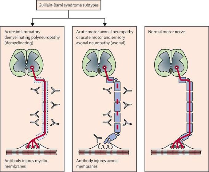 Guillaine-barre syndrome types