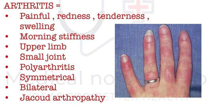 SLE- Arthritis