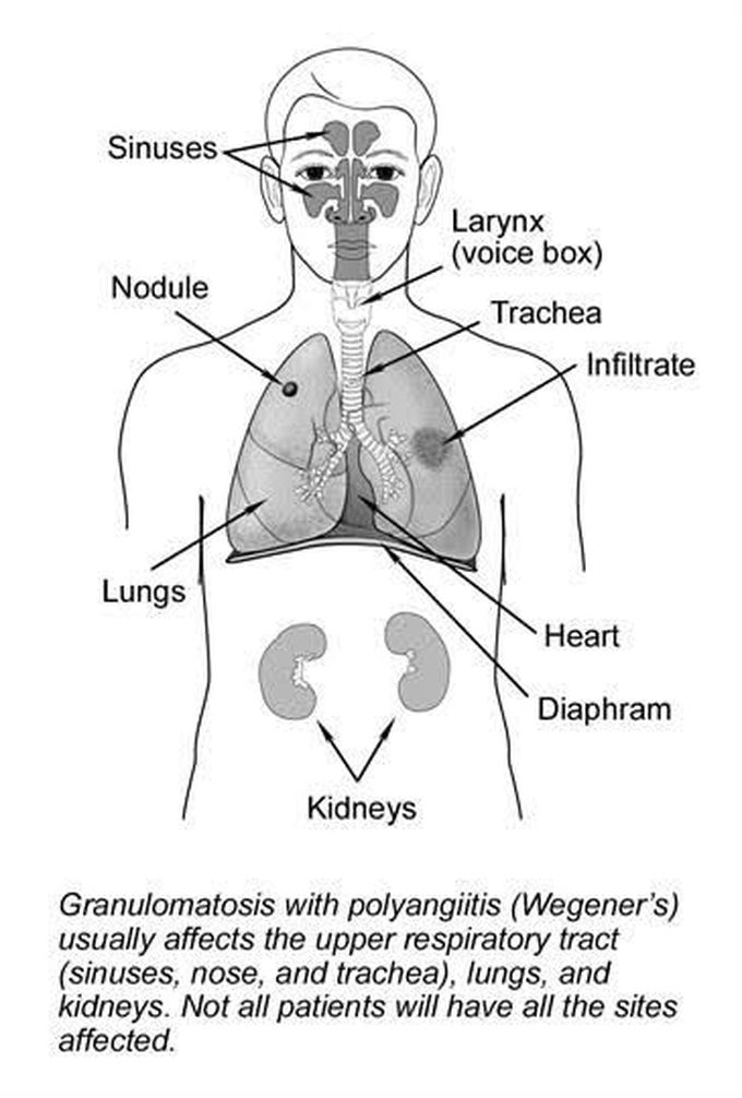 Wegners granulomatosis