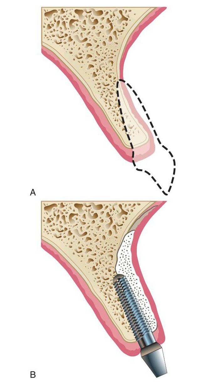Deficient anterior maxillary ridge - MEDizzy
